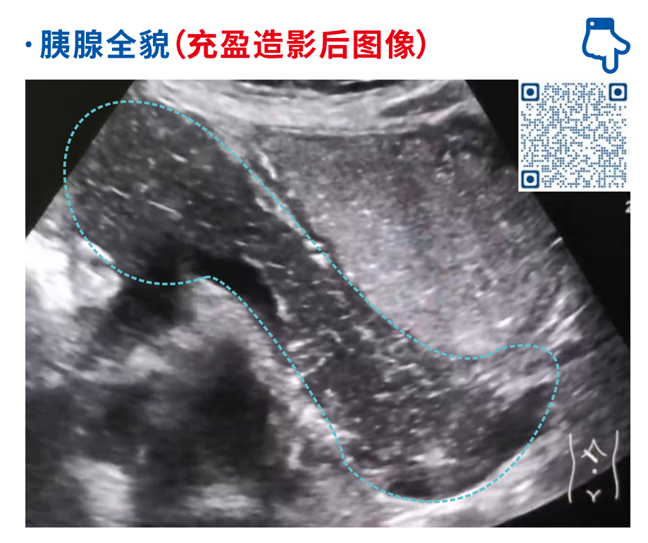 造影超声 + AI 分析