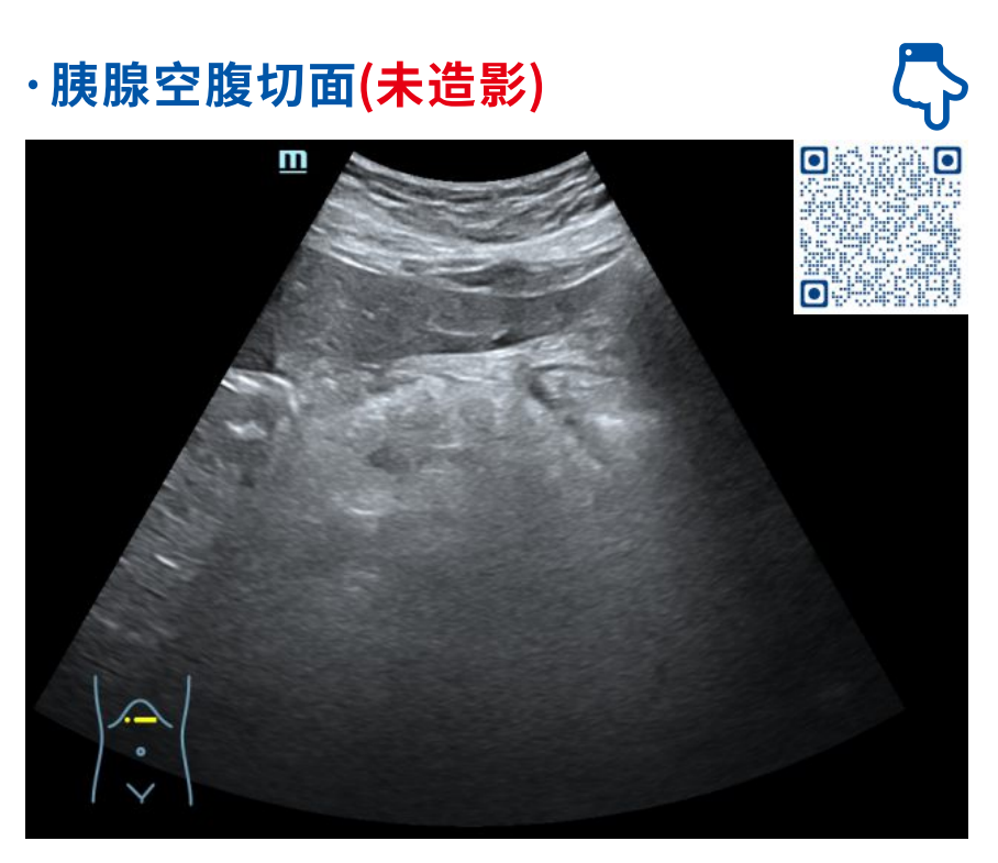 普通超声影像